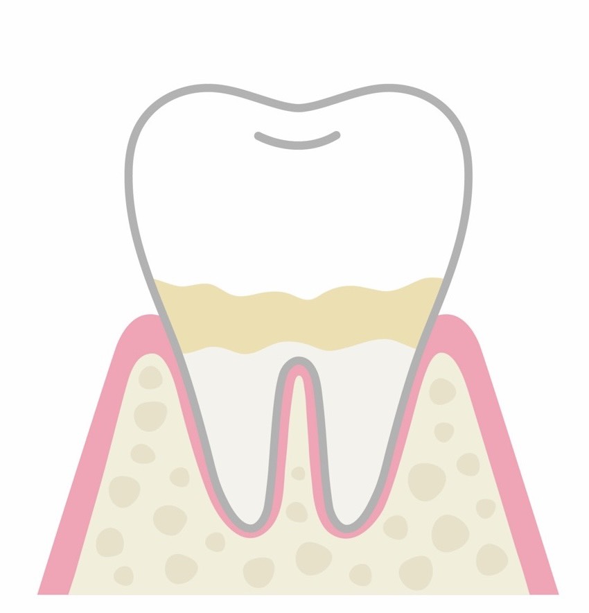 歯周病イメージ