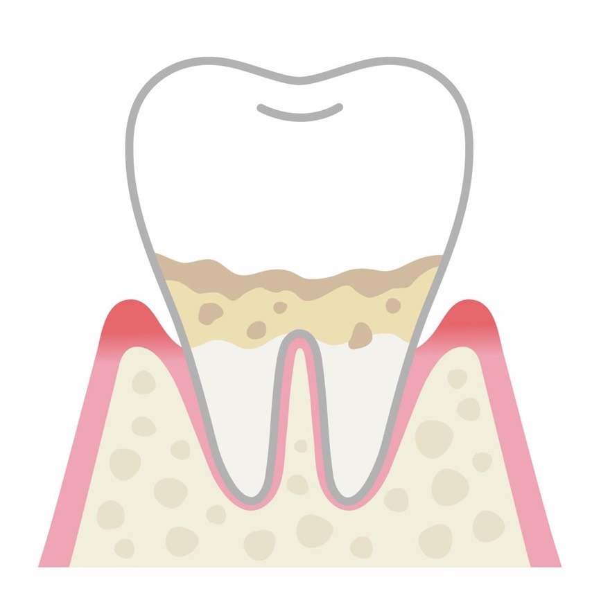 歯周病イメージ