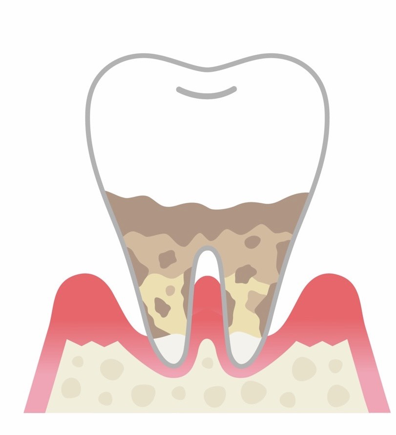 歯周病イメージ